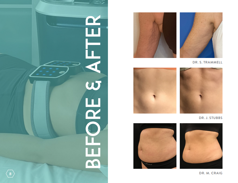 Before & After Photos:

underarms/triceps
abdomen
belly fat/adipose tissue