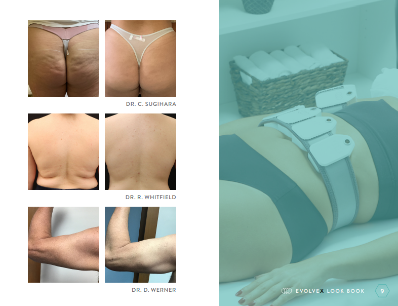 cellulite on buttock
back fat/flanks
arms/biceps/triceps
